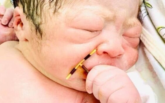 Малюк народився тримаючи спіраль у руці: фото, яке облетіло увесь світ